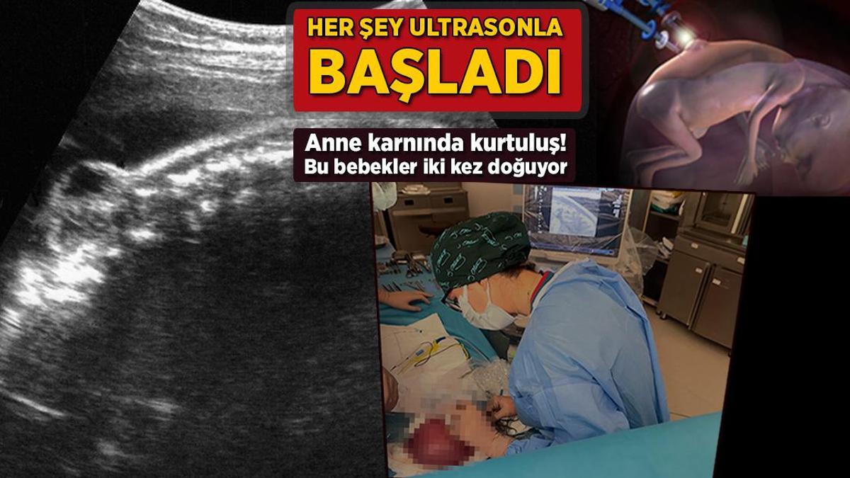 Anne Karnında Çığır Açan Operasyon: Bebek Theo'nun Hayatını Kurtardı